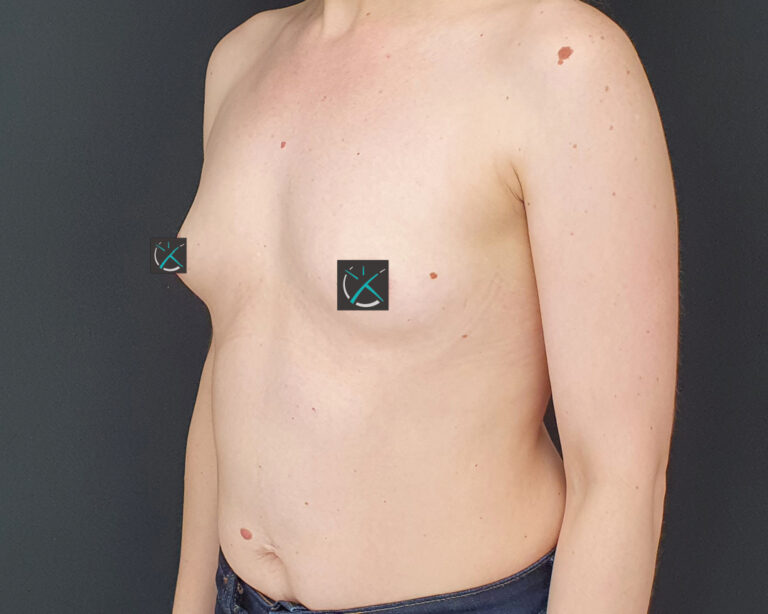 Before — Breast Augmentation