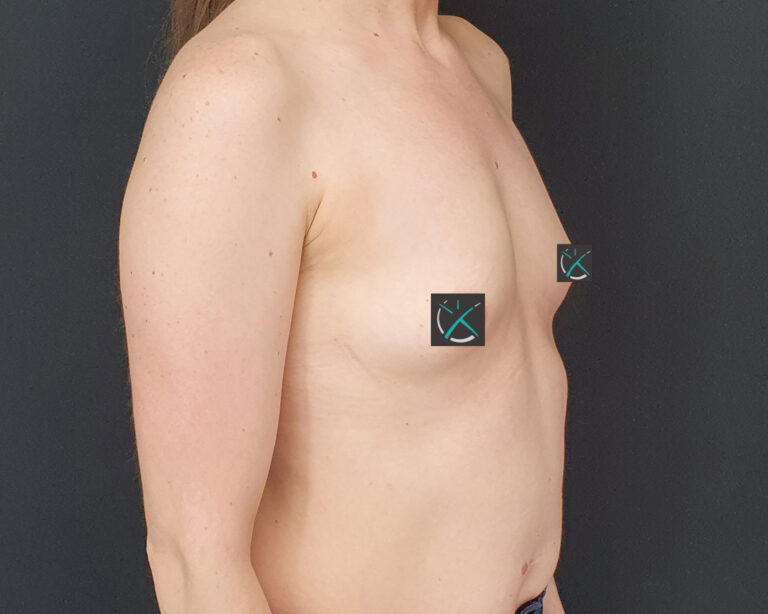 Before — Breast Augmentation