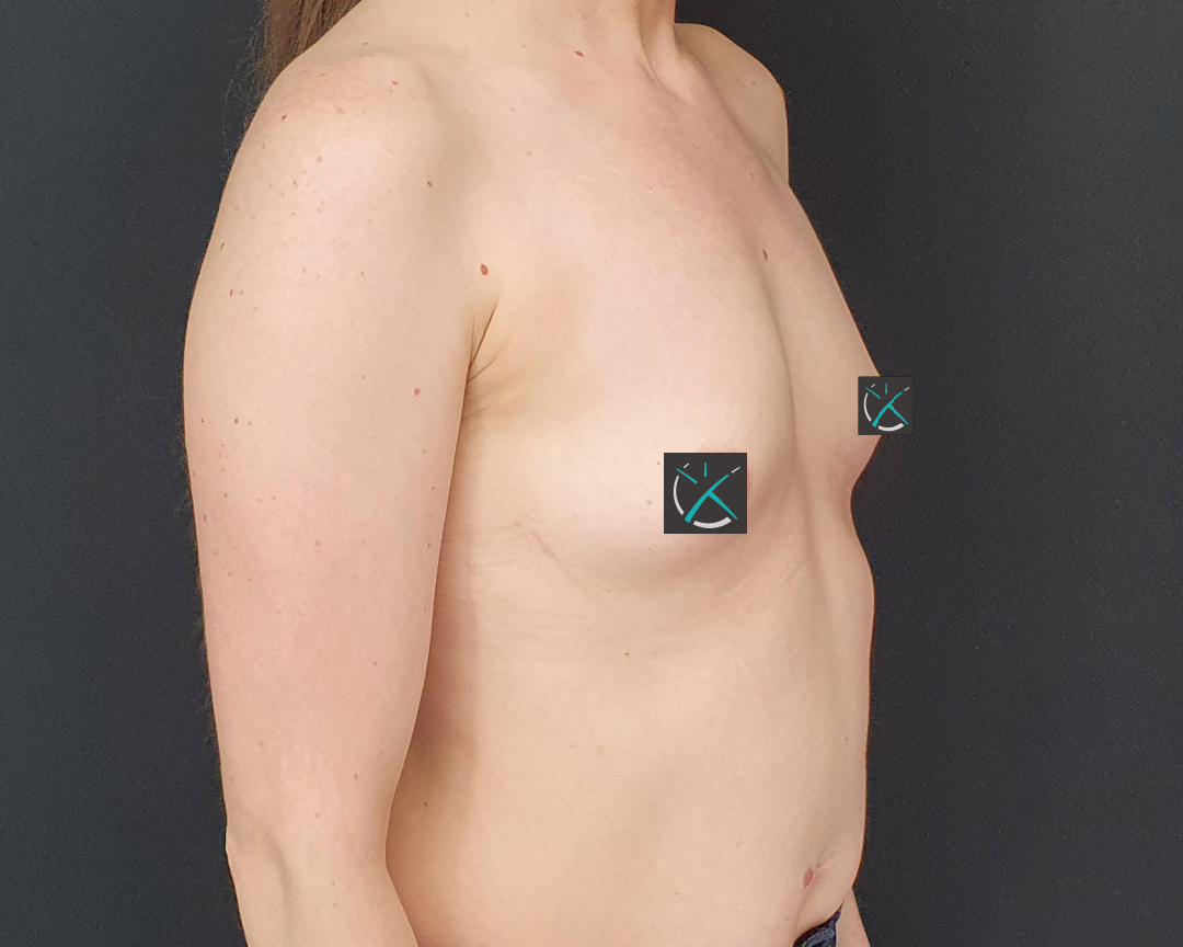 Before Breast Augmentation