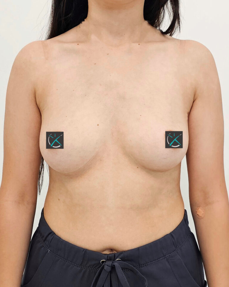 Before — Breast Augmentation