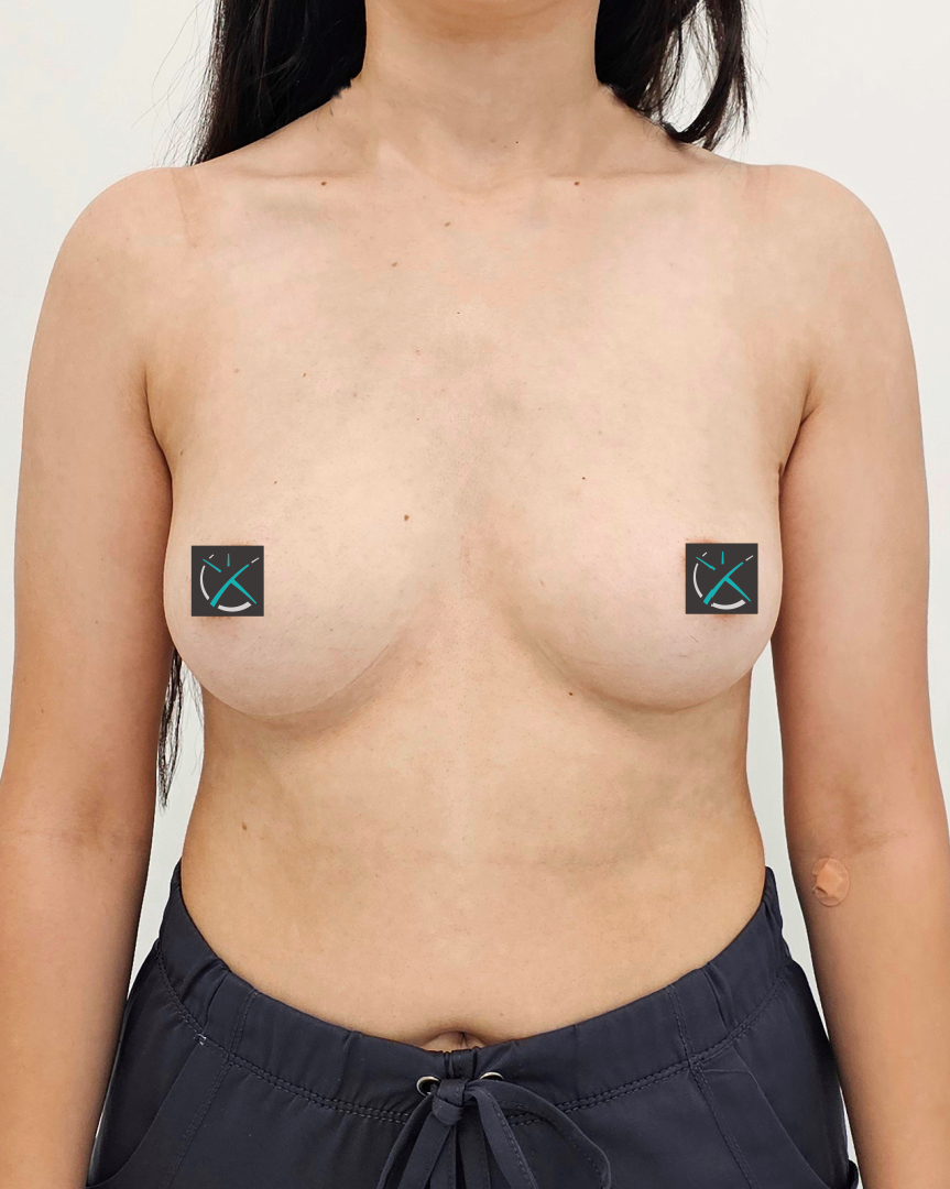 Before Breast Augmentation