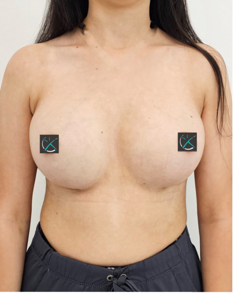 After — Breast Augmentation