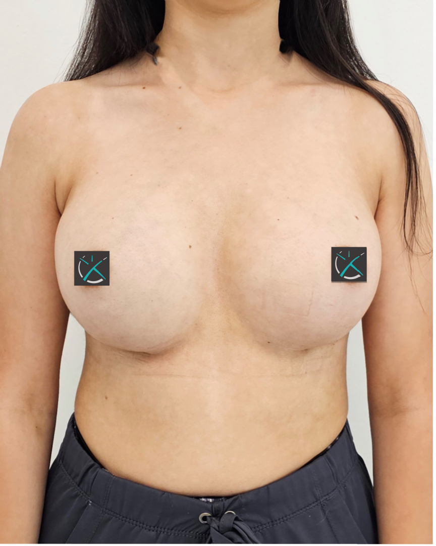 After Breast Augmentation